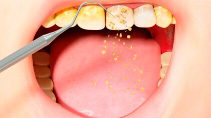Éliminer le tartre des dents naturellement chez vous : l’astuce la plus simple et la plus efficace