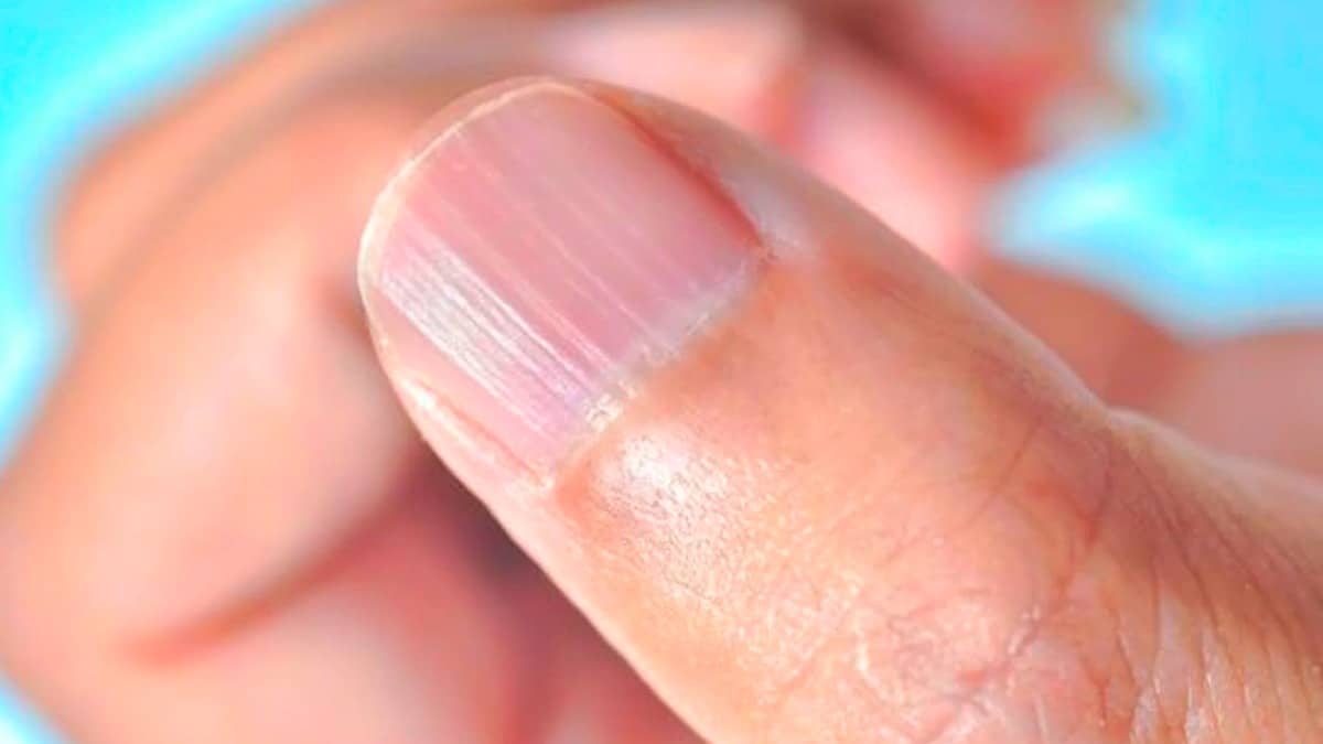 Des stries sur les ongles : le signe silencieux à ne surtout pas ignorer