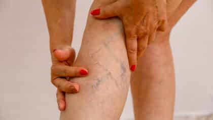 Ce jus aide à combattre les varices et à réduire les varicosités et le gonflement des jambes naturellement