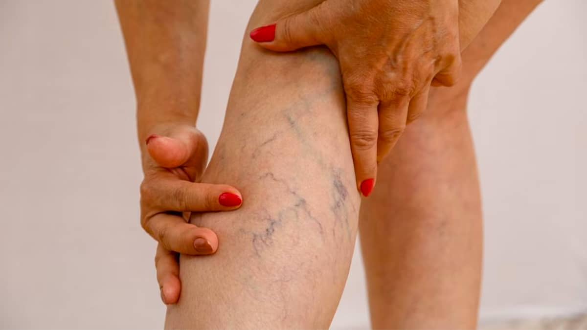 Ce jus aide à combattre les varices et à réduire les varicosités et le gonflement des jambes naturellement