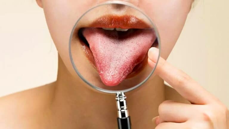 La couleur de votre langue peut révéler des problèmes de santé : voici quand vous inquiéter