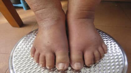 Soulagez facilement vos pieds gonflés avec ce remède de grand-mère incroyable