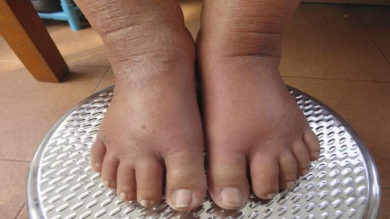 Soulagez facilement vos pieds gonflés avec ce remède de grand-mère incroyable