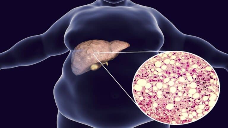 Ballonnements et gaz digestifs : quel lien avec la stéatose hépatique ?