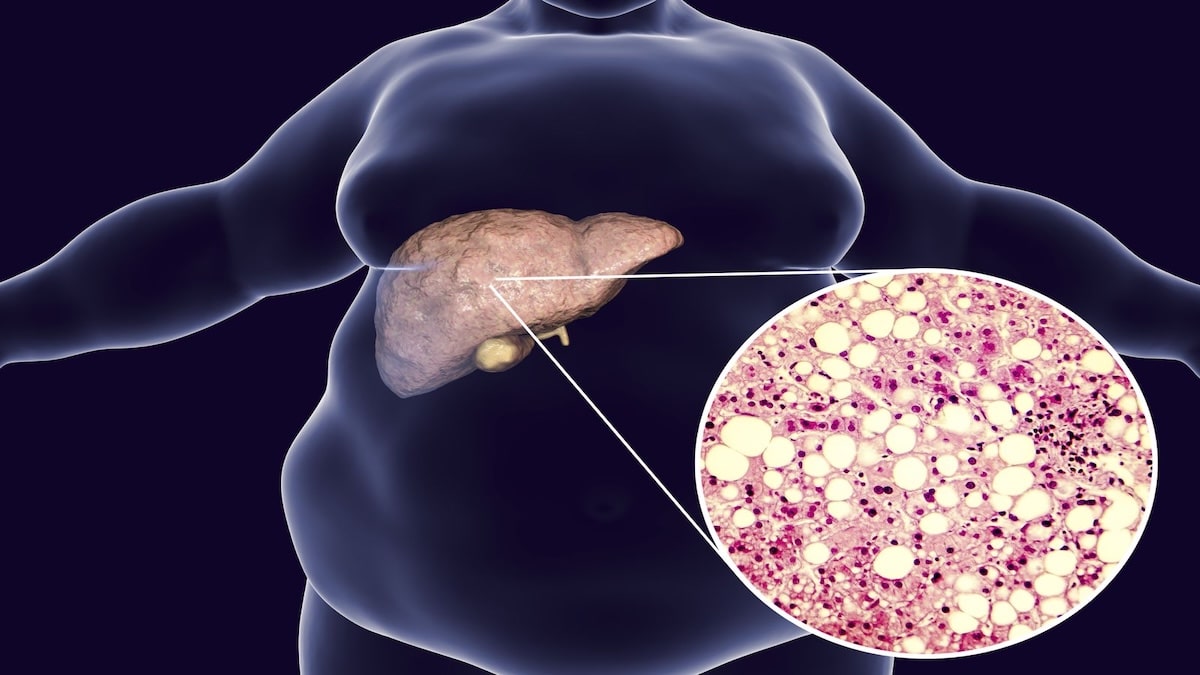 Ballonnements et gaz digestifs : quel lien avec la stéatose hépatique ?