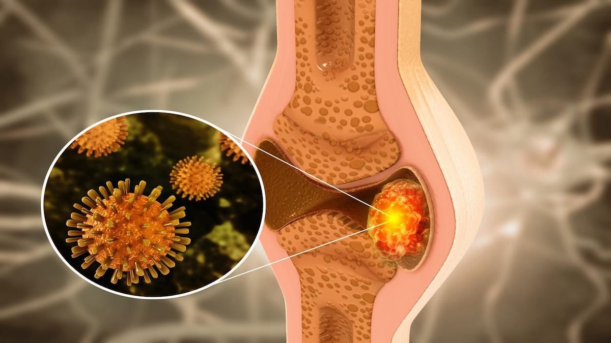 Tout savoir sur le cancer des os : signaux d’alerte et explications