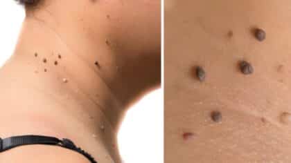 Ce remède naturel redoutable fait disparaître les acrochordons rapidement