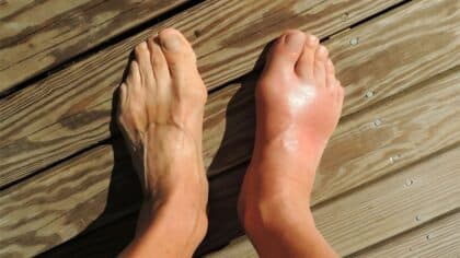Pieds enflés : causes, signes et traitements podologiques