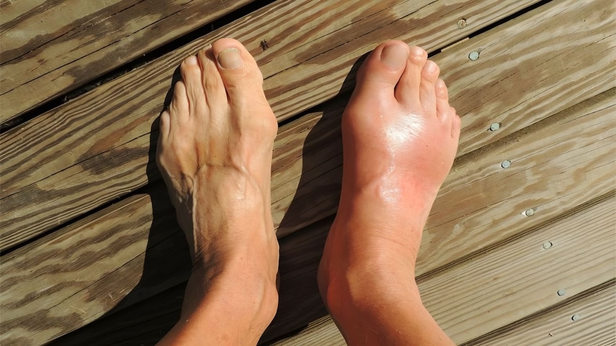 Pieds enflés : causes, signes et traitements podologiques