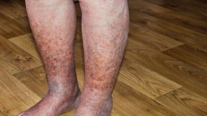 Dermatite de stase : signes, origines et solutions thérapeutiques