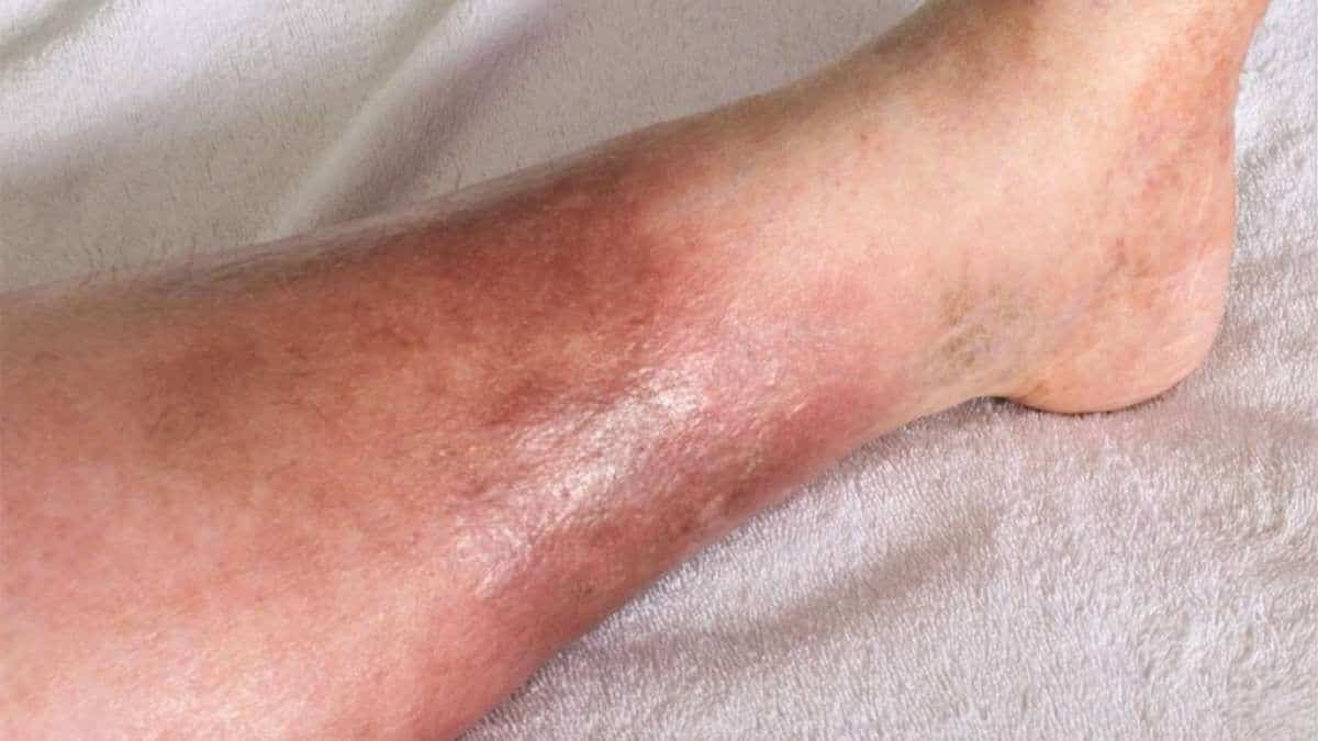 Coloration à l’hémosidérine : quelles sont les causes du brunissement des jambes ?