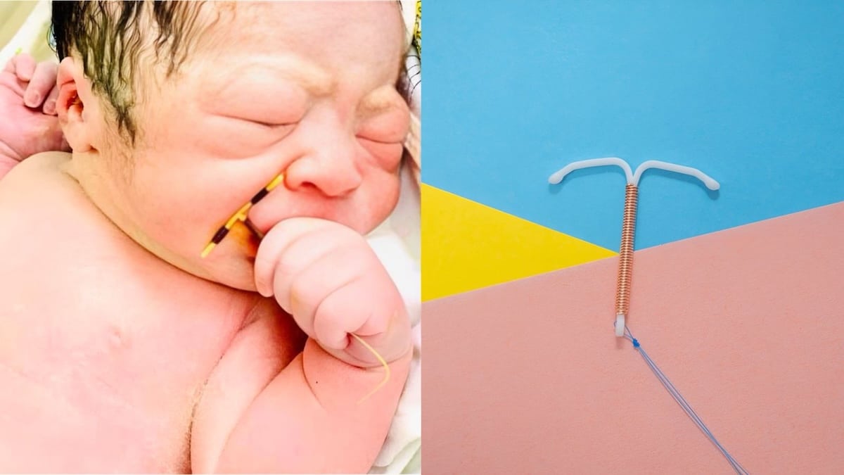 Un bébé naît avec un stérilet dans la peau, un cas rare qui intrigue la médecine