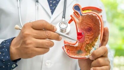 Cancer de l’estomac : quels sont les facteurs de risque ?