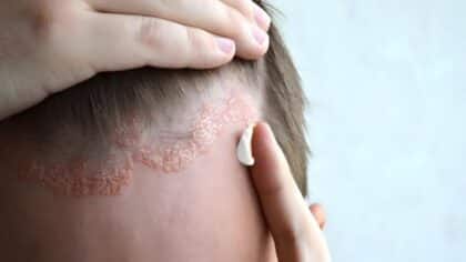 Pellicules, dermatite séborrhéique et psoriasis : pourquoi ces troubles peuvent s’aggraver en été