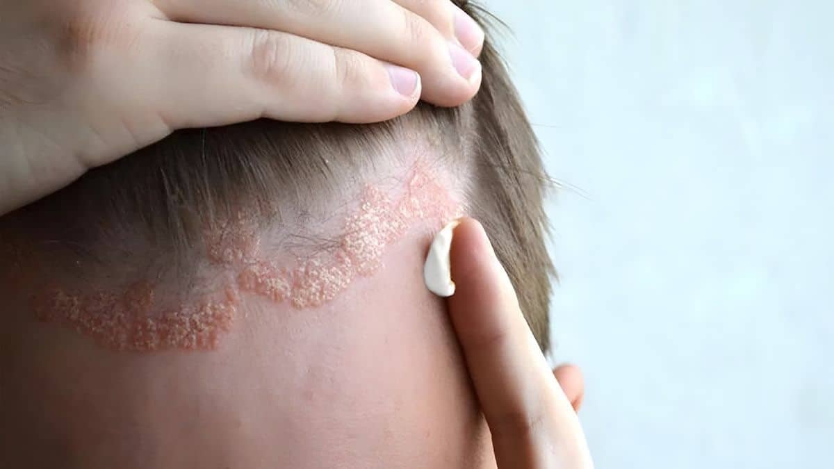 Pellicules, dermatite séborrhéique et psoriasis : pourquoi ces troubles peuvent s’aggraver en été