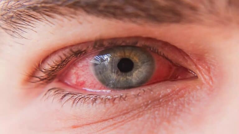Tout savoir sur la conjonctivite : causes, formes cliniques et solutions
