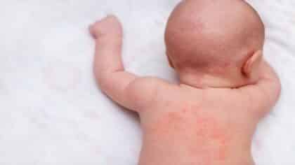 Mon enfant a de l’urticaire : est-ce forcément lié à une allergie ?
