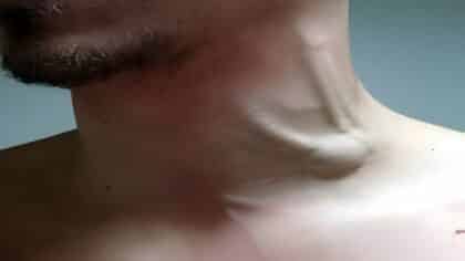 Veine jugulaire distendue : identifier les signes et mesurer les risques d’une maladie rare