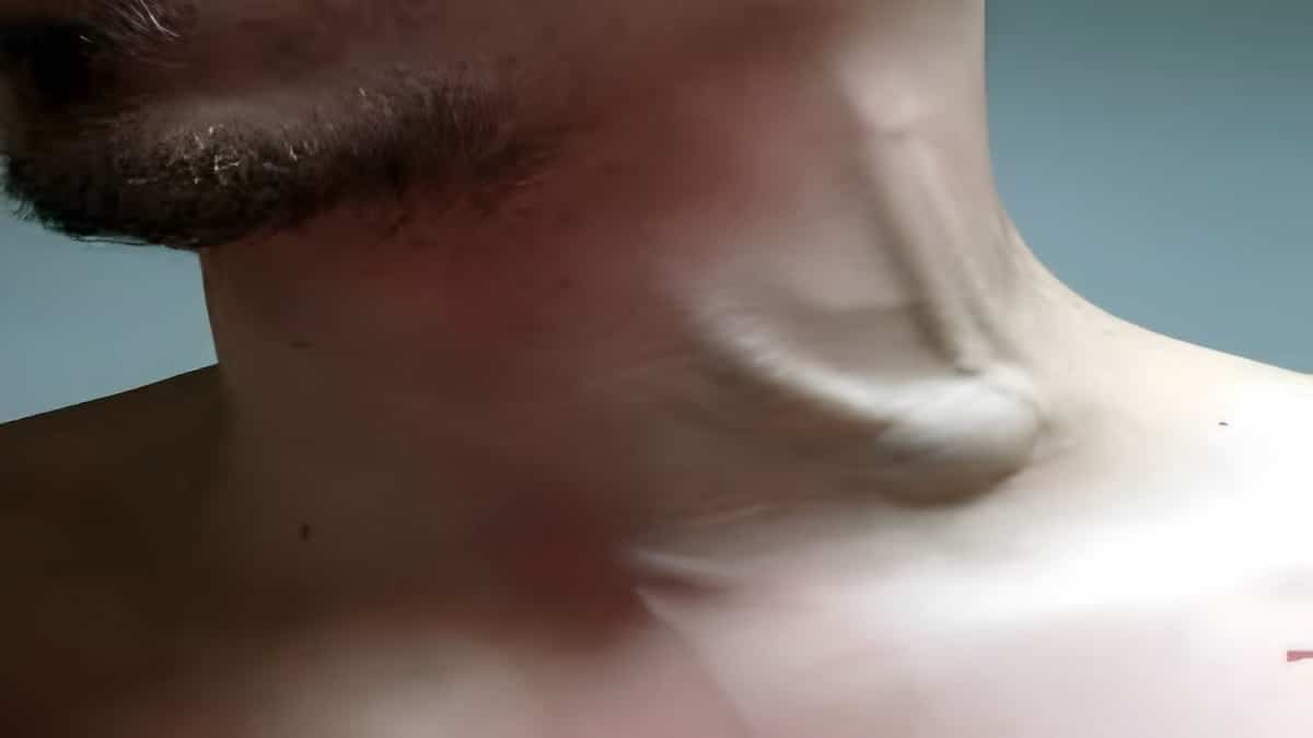 Veine jugulaire distendue : identifier les signes et mesurer les risques d’une maladie rare