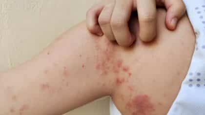 Miliaria : causes, symptômes et solutions efficaces pour la soulager