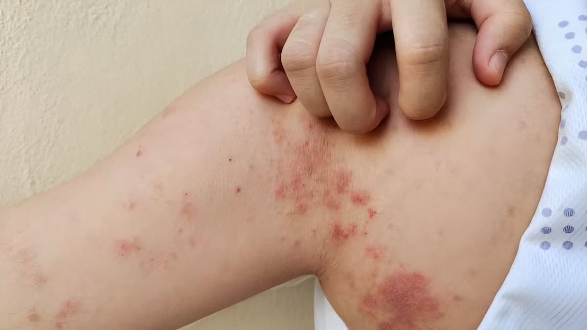 Miliaria : causes, symptômes et solutions efficaces pour la soulager