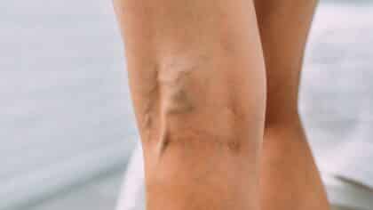 Veines variqueuses : 5 dangers cachés à ne pas ignorer