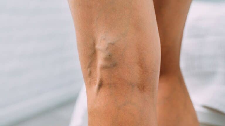 Veines variqueuses : 5 dangers cachés à ne pas ignorer