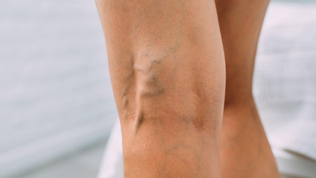 Veines variqueuses : 5 dangers cachés à ne pas ignorer