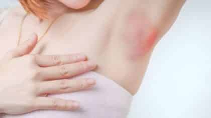 Démangeaisons des aisselles : causes, symptômes et solutions efficaces