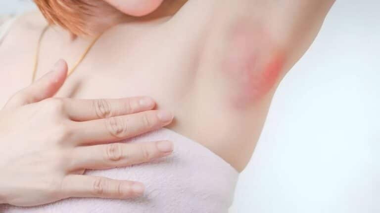 Démangeaisons des aisselles : causes, symptômes et solutions efficaces