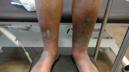 Dermatite de stase : signes, origines et solutions thérapeutiques