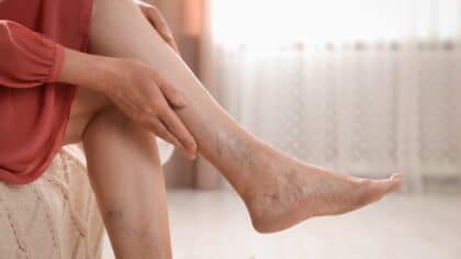 Pieds avec veines gonflées : quelles causes et comment y remédier