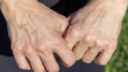 Veines visibles : causes, signes à surveiller et solutions simples au quotidien