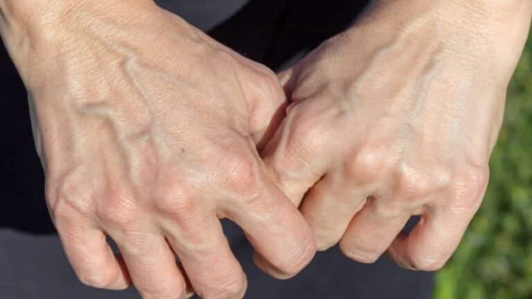 Veines visibles : causes, signes à surveiller et solutions simples au quotidien