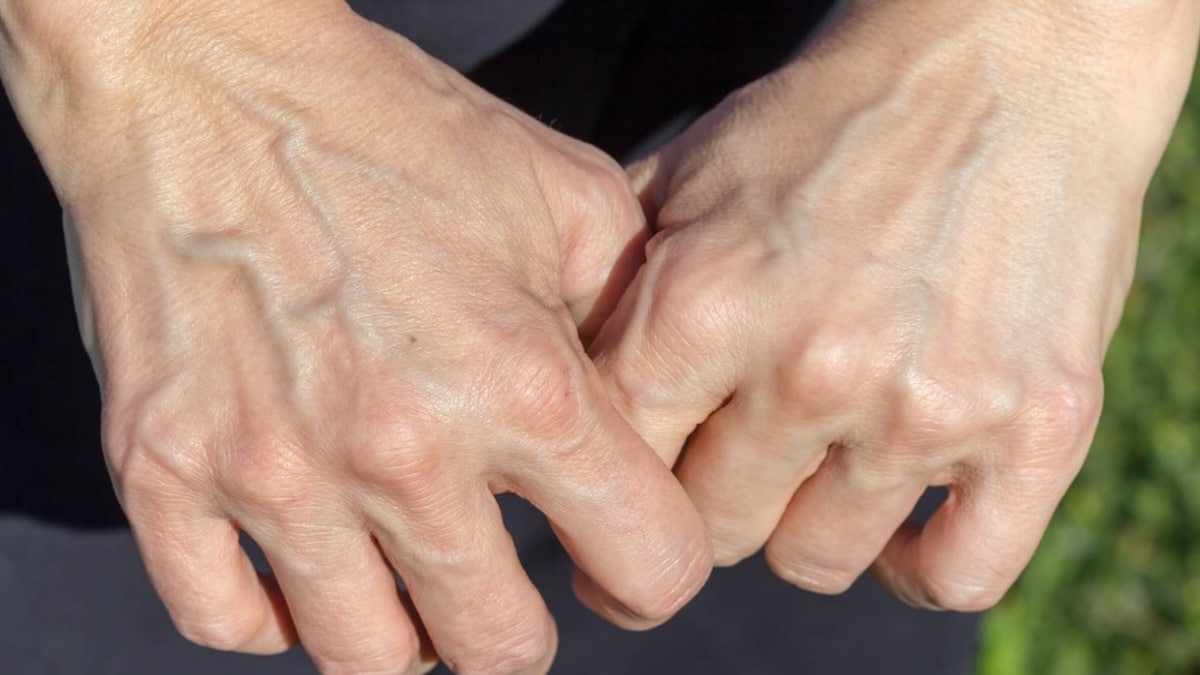 Veines visibles : causes, signes à surveiller et solutions simples au quotidien