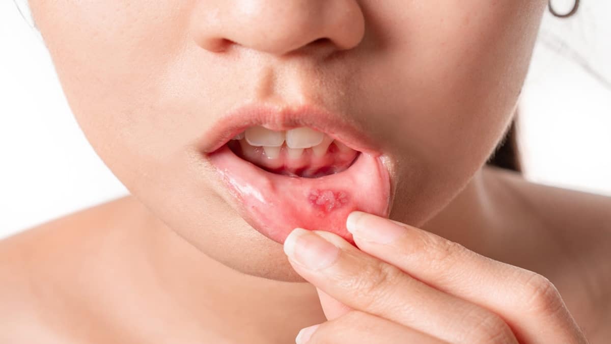 Aphtes récurrents ? Voici 5 astuces efficaces pour les faire disparaître plus vite