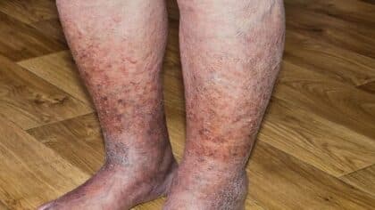 Dermatite de stase : causes, symptômes et comment la traiter sans complications : ce que personne ne vous dit et ce que vous devez savoir