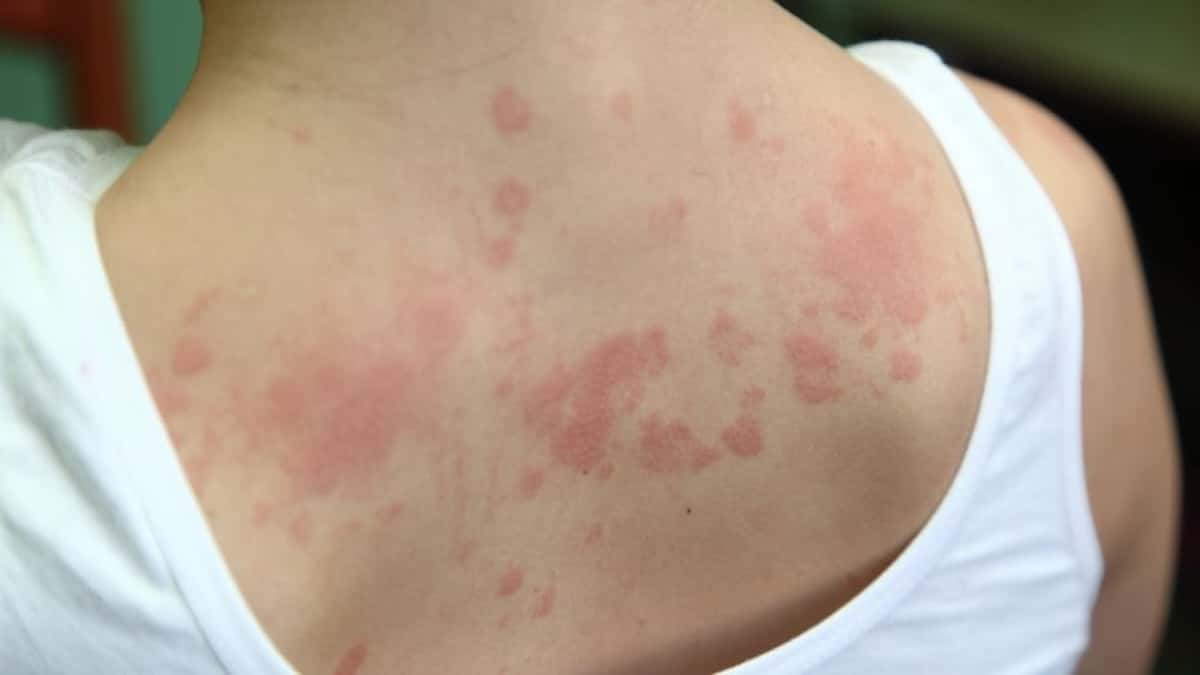Changements cutanés qui reflètent des problèmes de santé : qu’indiquent ces signes ?