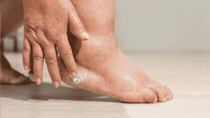 Gonflement des chevilles, des pieds et des jambes : quand faut-il s’inquiéter ?