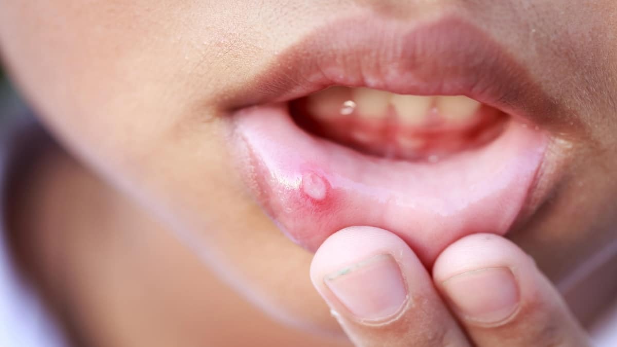 Attention ! Un aphte peut être le premier symptôme de ces cinq maladies.