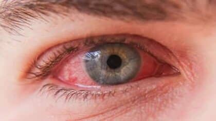 Maladies et affections oculaires : symptômes, causes courantes et comment les détecter tôt