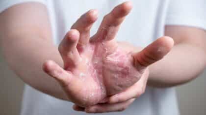 Pourquoi les mains pèlent-elles ? Causes et conseils pour les prévenir