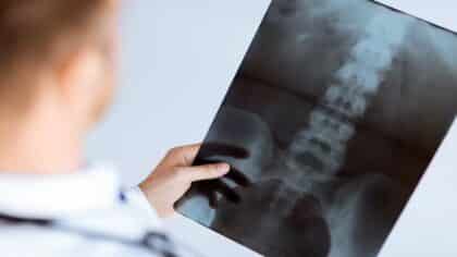 Les médecins sont choqués par ces radiographies : ce qu'ils ont découvert dans leurs articulations vous laissera sans voix