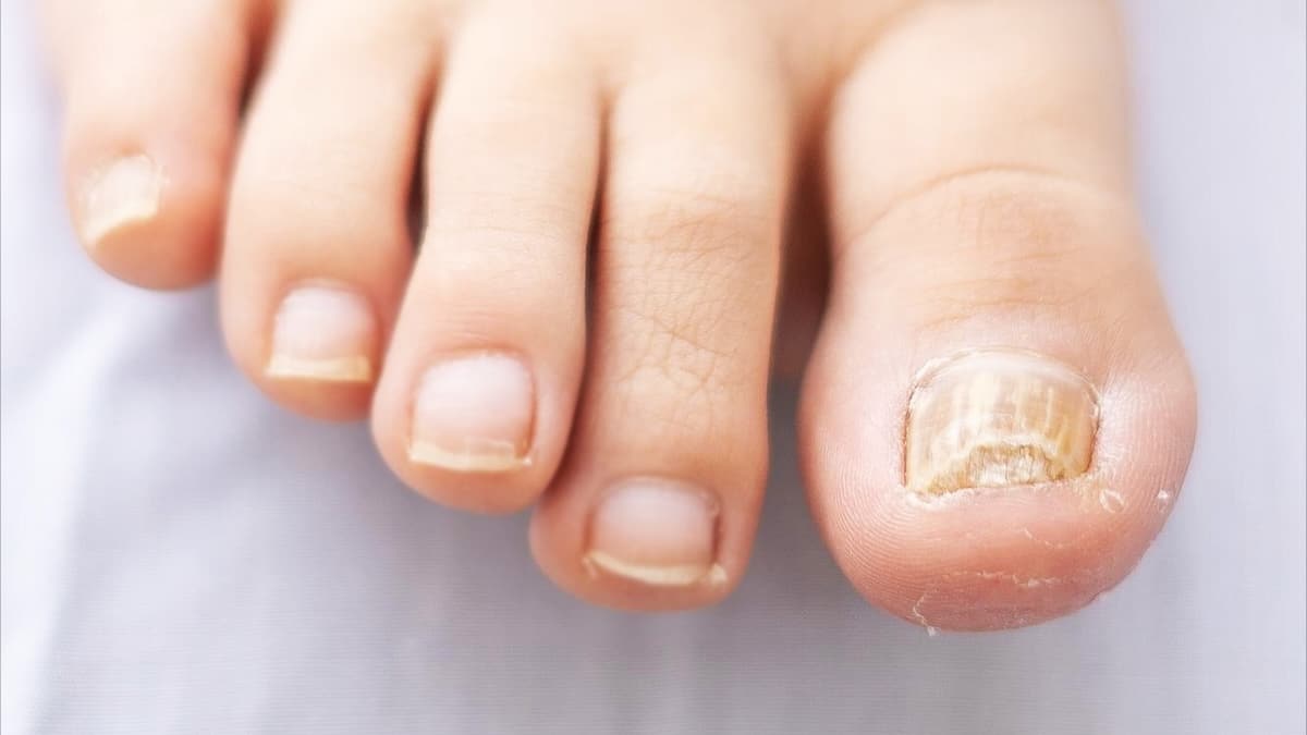 Vos ongles sont plus épais que la normale ? Découvrez pourquoi et comment les traiter