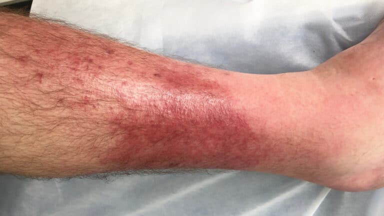 Une jambe rouge et gonflée soudainement : causes et risques qui pourraient vous sauver la vie