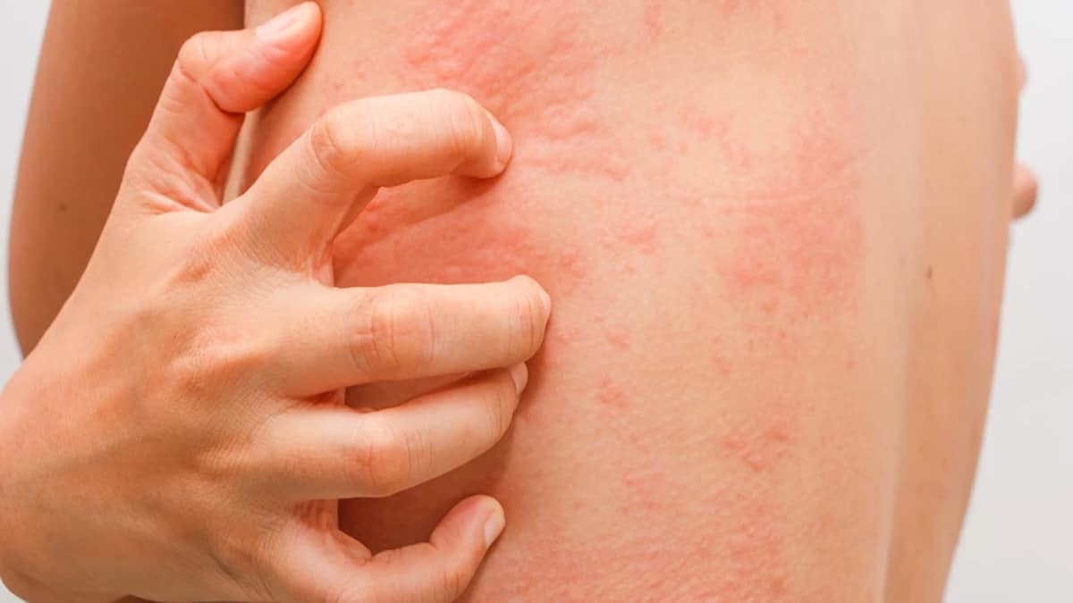 Démangeaisons, rougeurs ou boutons ? Il pourrait s'agir de teigne. Apprenez à la reconnaître