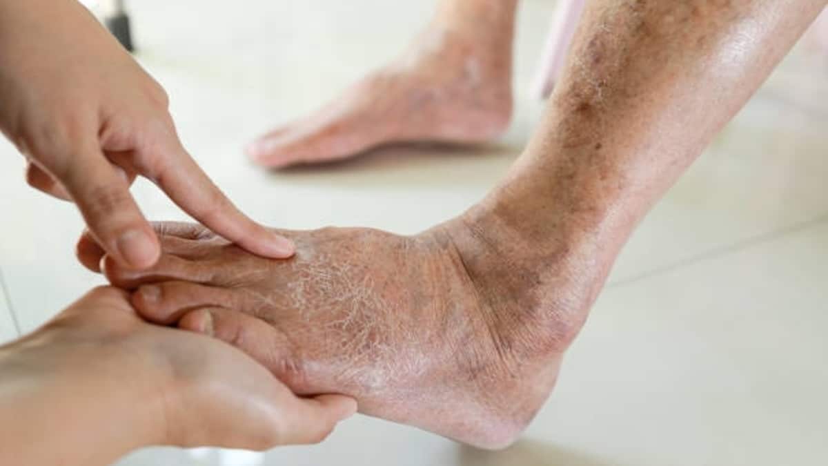 Avez-vous les mains et les pieds gonflés ? Votre corps pourrait vous envoyer un avertissement silencieux