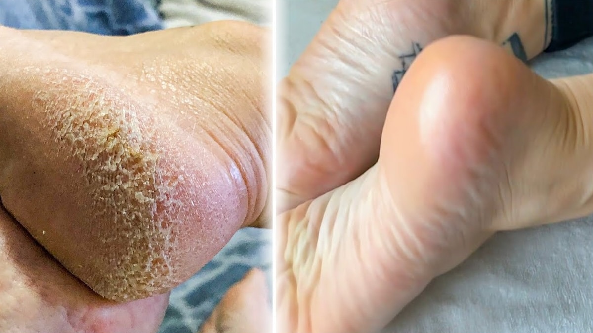 « Le briseur de champignons » : le secret pour éliminer les mycoses et les callosités des pieds en une seule étape