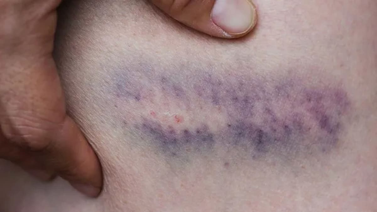 Pourquoi des ecchymoses apparaissent-elles sans raison ? Attention, cela pourrait être un signe avant-coureur !
