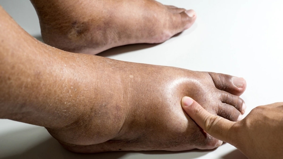 Avez-vous les pieds gonflés ? Ces Maladies pourraient en être la cause